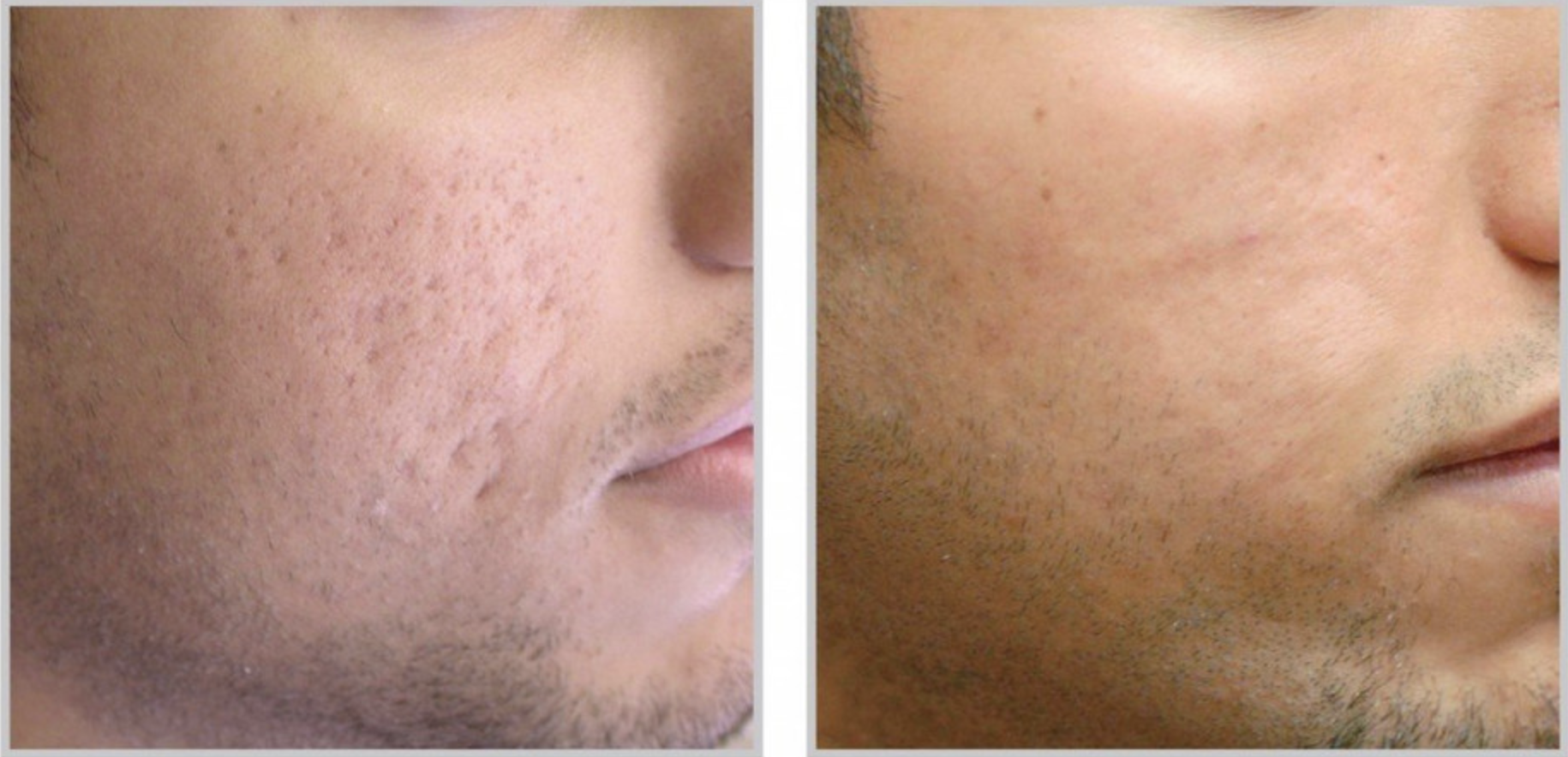 PRP for Acne Scars